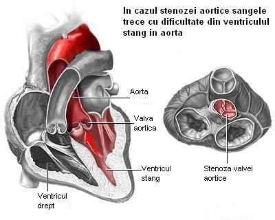 imagine cu stenoza aortica